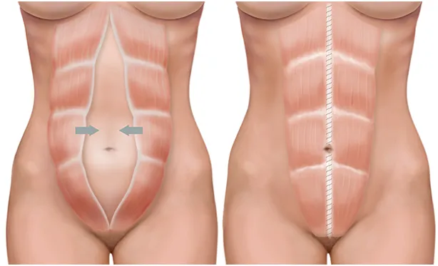 Tummy Tuck Inland Empire
