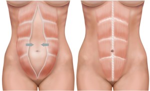 tummy-tuck-image