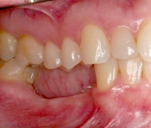 Dental Implant Bone Loss 
