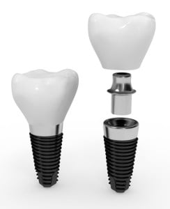 Dental Implant in Inland Empire
