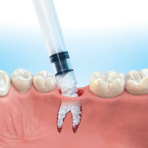 Dental Implant Inland Empire Bone raft