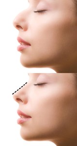 Rhinoplasty Nose Job Inland Empire