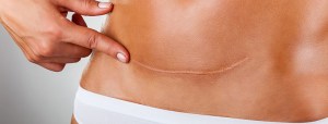 Tummy Tuck Scar Inland Empire