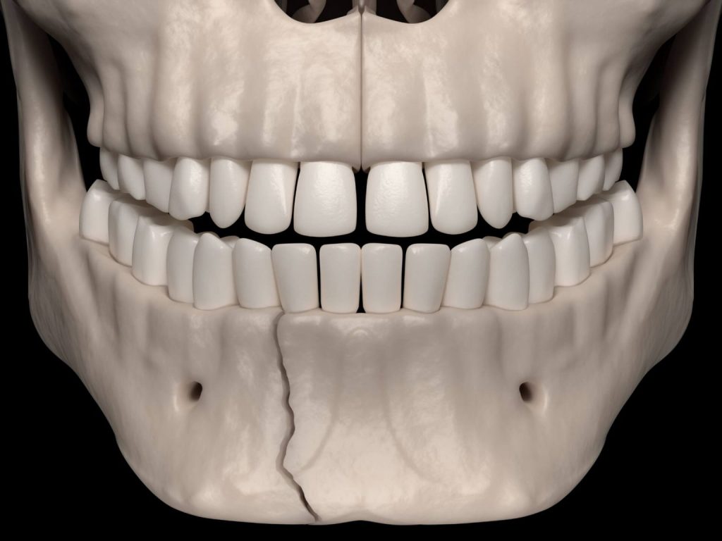 What to Expect When Recovering from a Broken Jaw