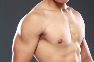 Gynecomastia Surgery: One Of The Most Requested Procedures