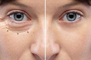 Myth #4: Blepharoplasty is a one-size-fits-all procedure