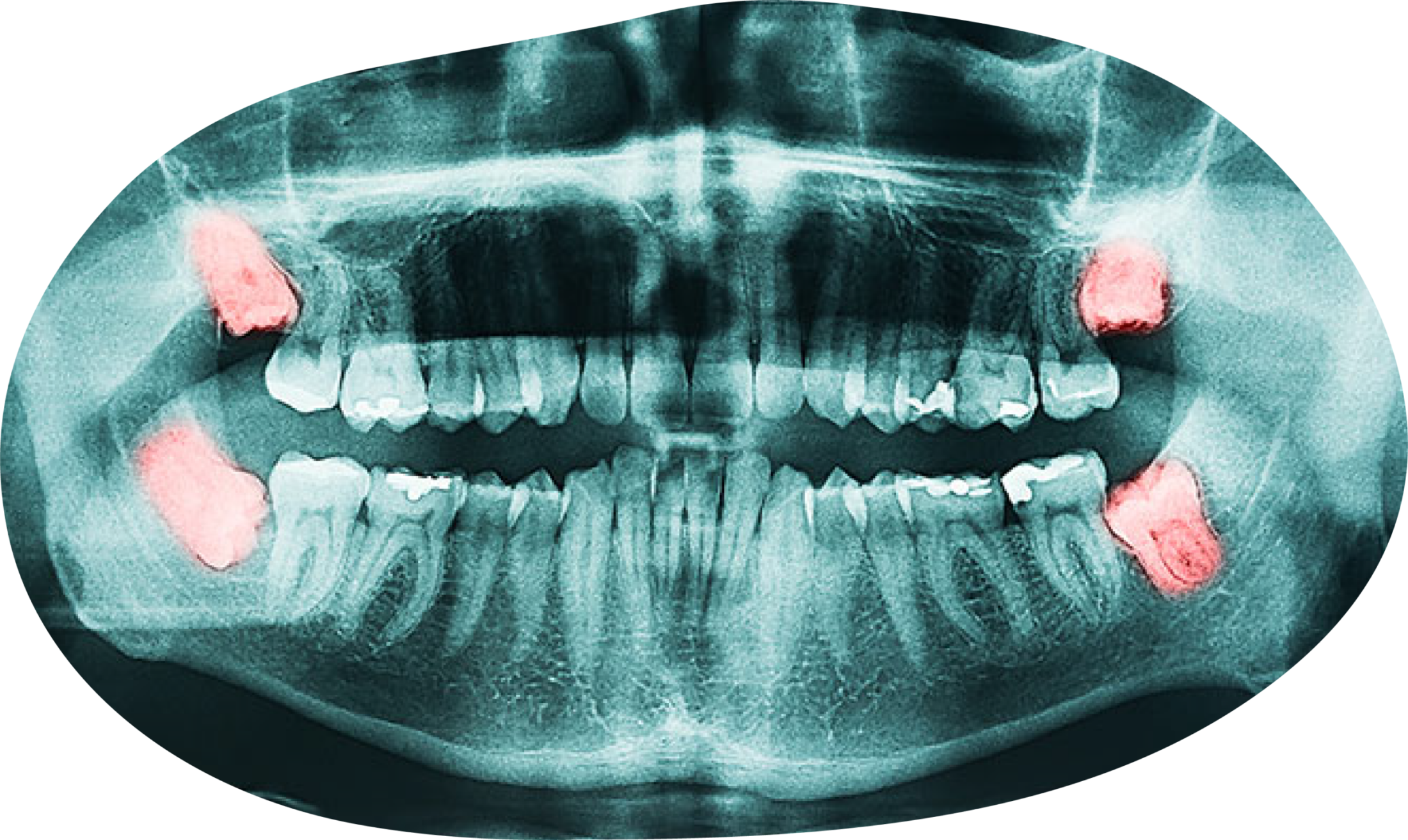 Advanced Surgical Solutions for Complex Wisdom Teeth Removal 