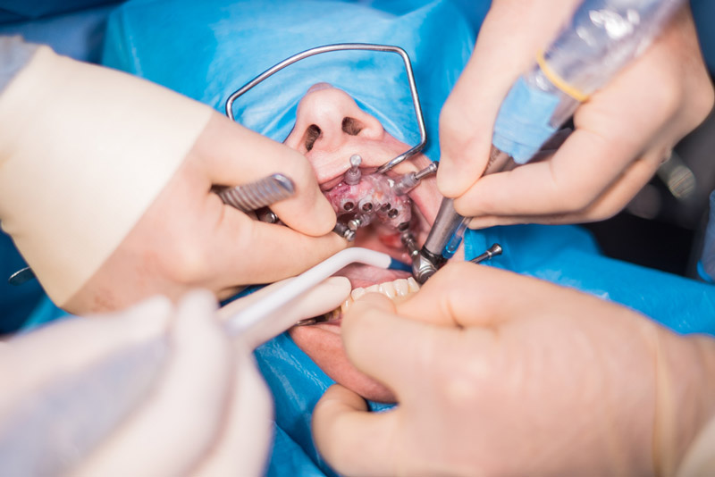 Dental Implants vs. Other Tooth Replacement Options: Why Oral Surgery is the Best Choice
