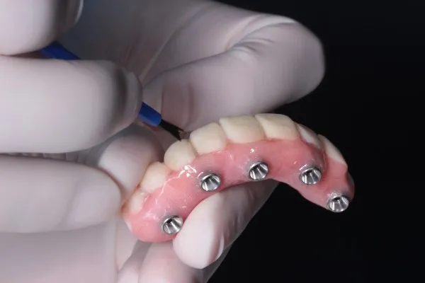 A New Smile in Just One Day: 7 Benefits of All-on-Four Implants