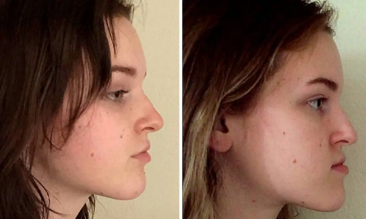 Post-Surgical Healing for Jaw Surgeries: The Importance of Proper Nutrition 