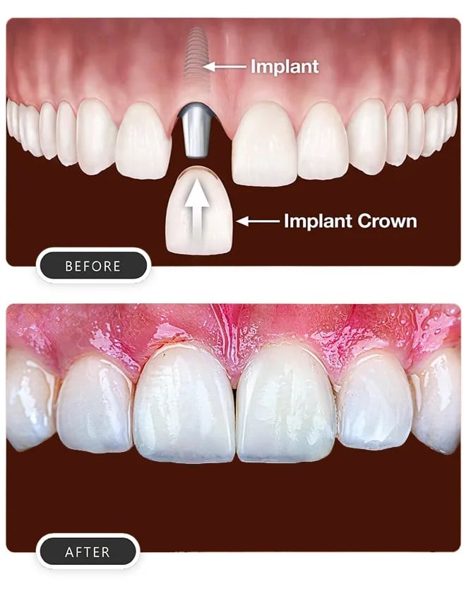 5 Reasons to Consider Dental Implants for a Permanent Solution to Missing Teeth